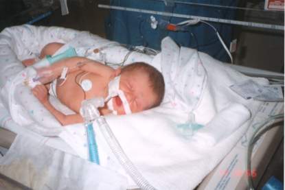 Makenzie on ventilator